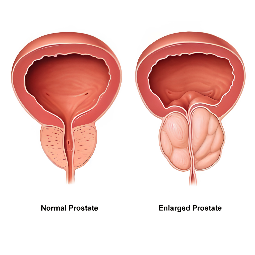 Enlarged Prostate (BPH)