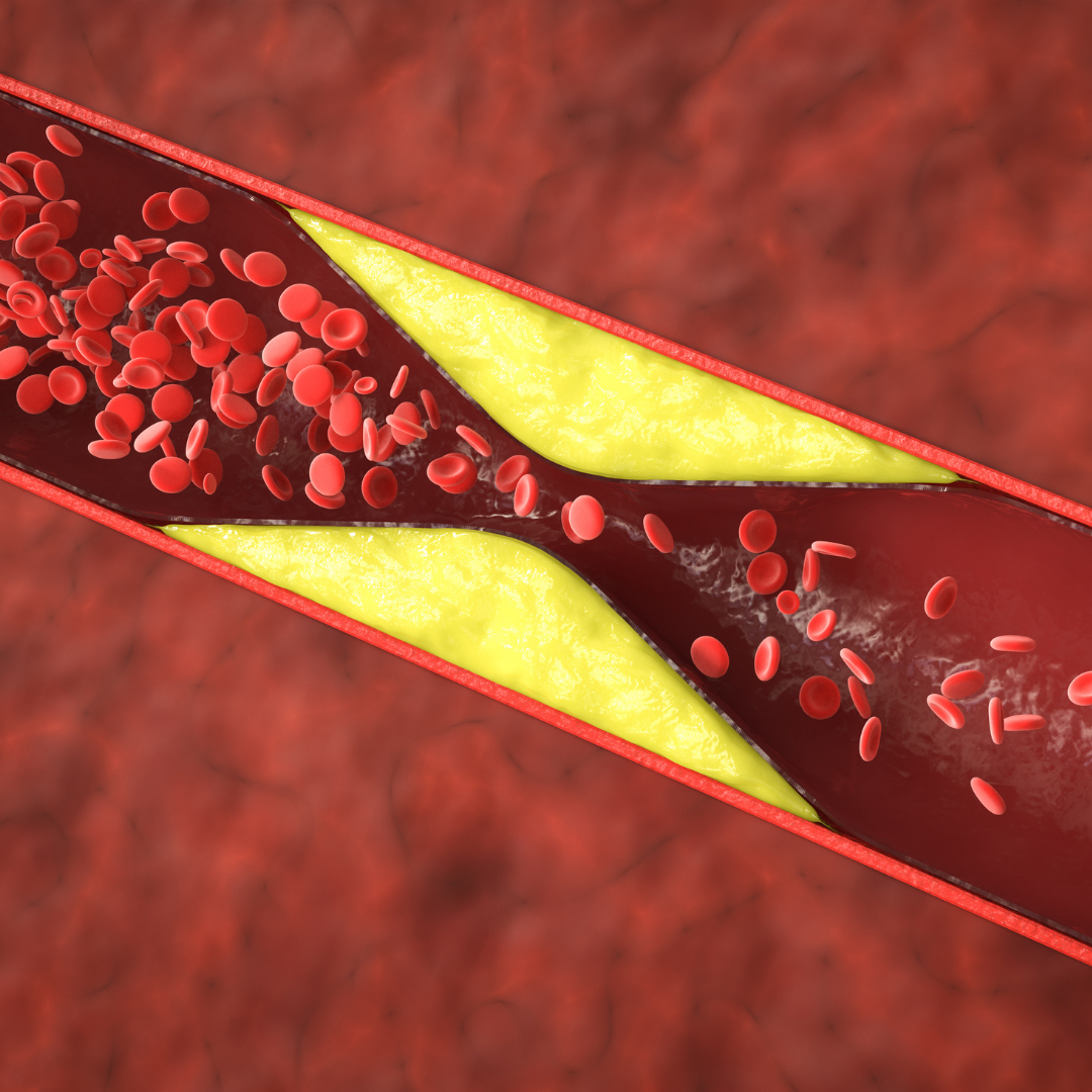 High Cholesterol