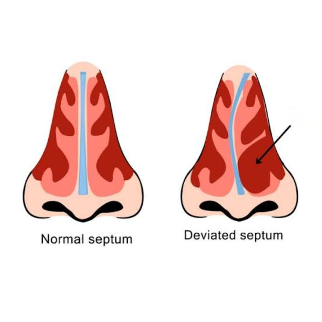 Deviated Nasal Septum