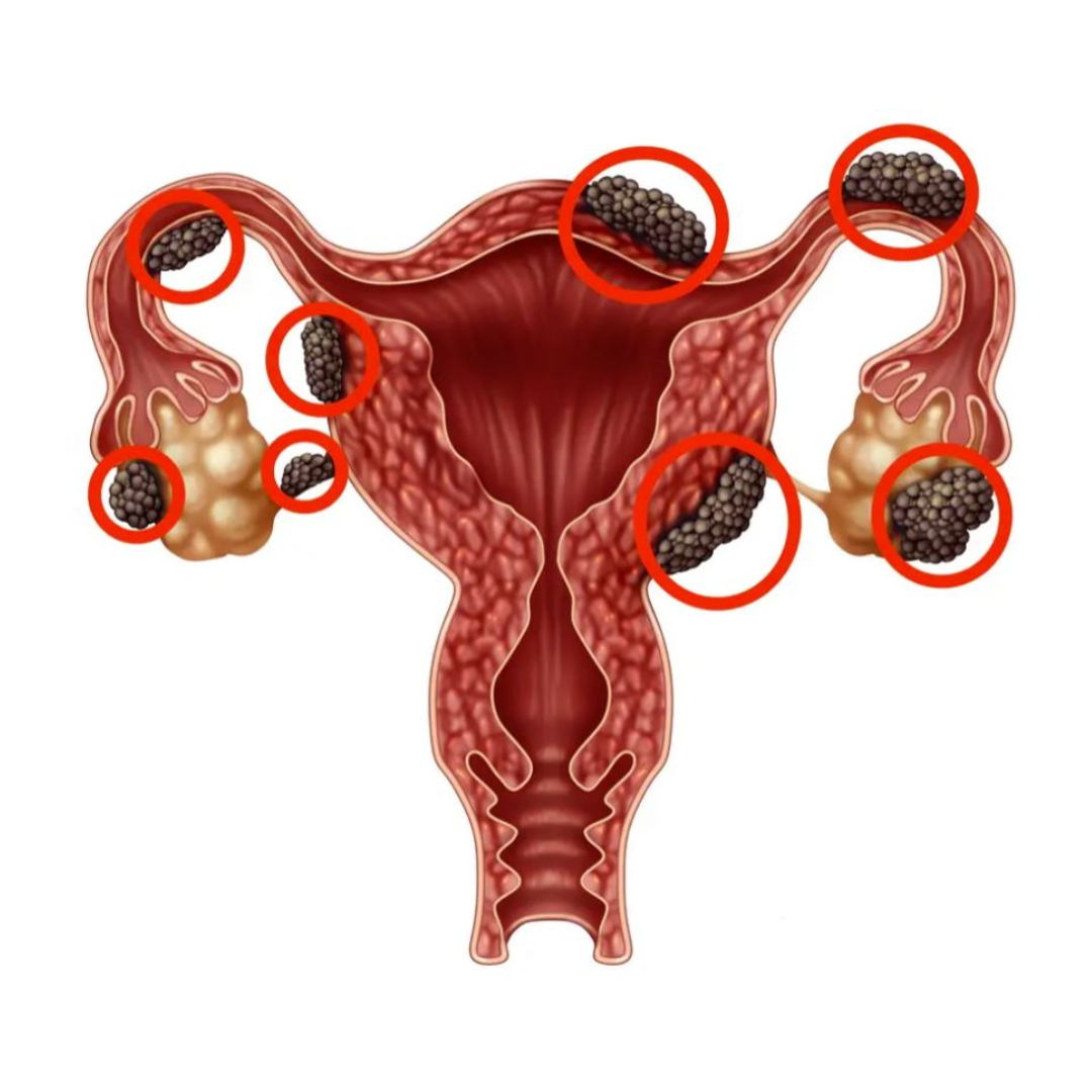 Endometriosis