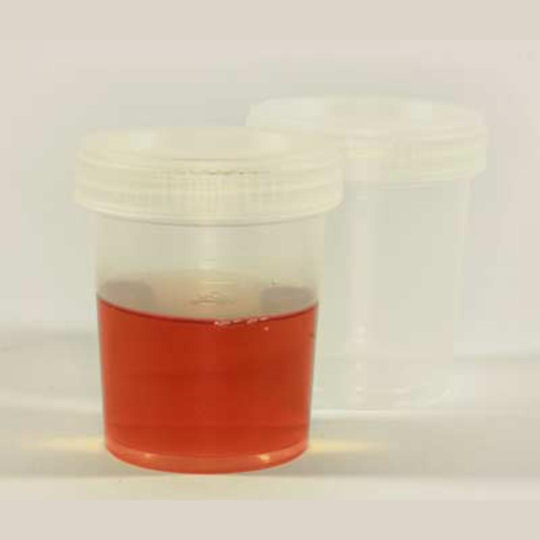 Blood in Urine (Hematuria)