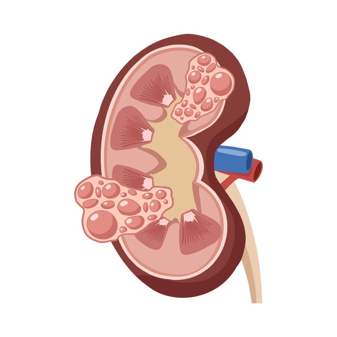 Kidney Cysts