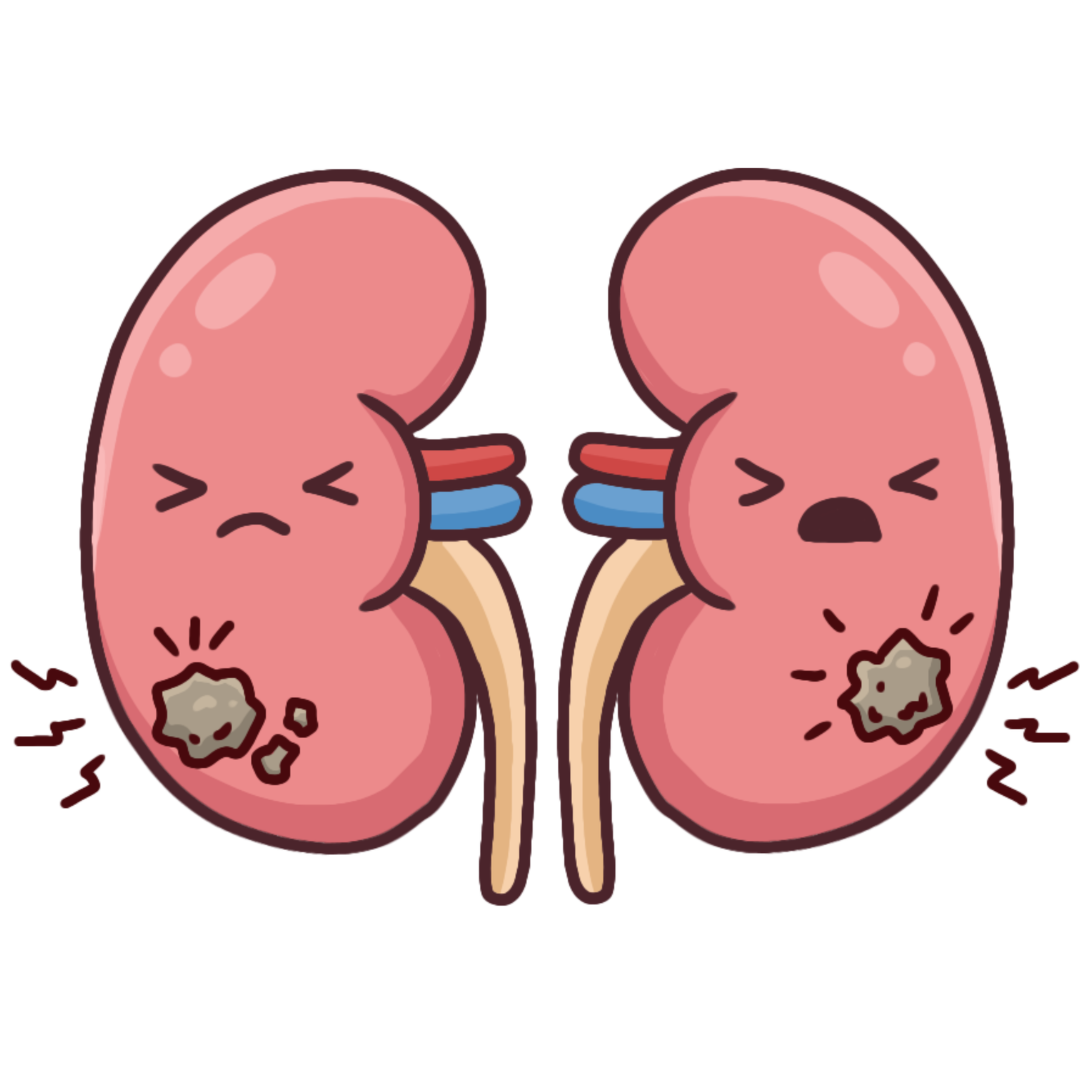 Kidney Stones