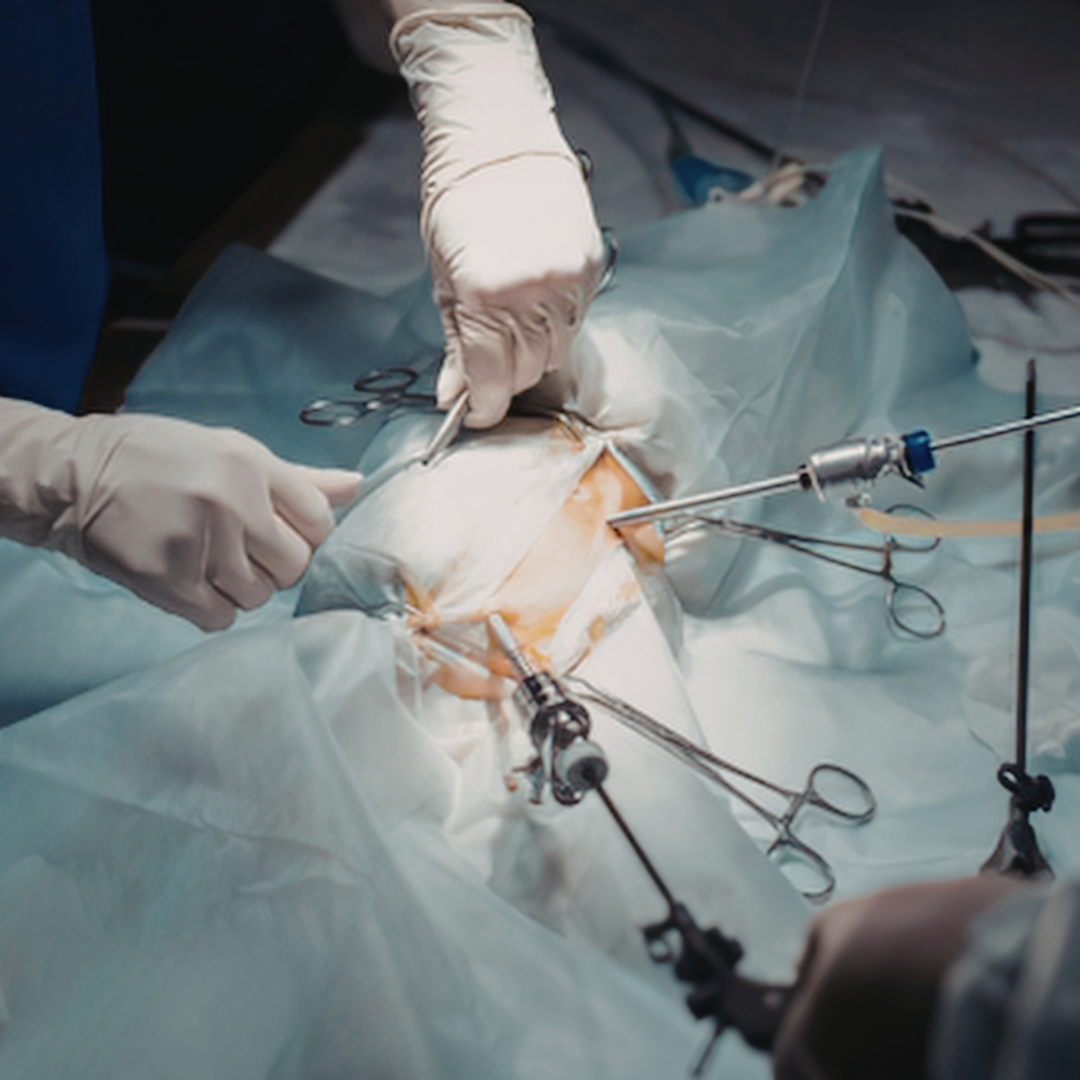 Laparoscopic Hysterectomy