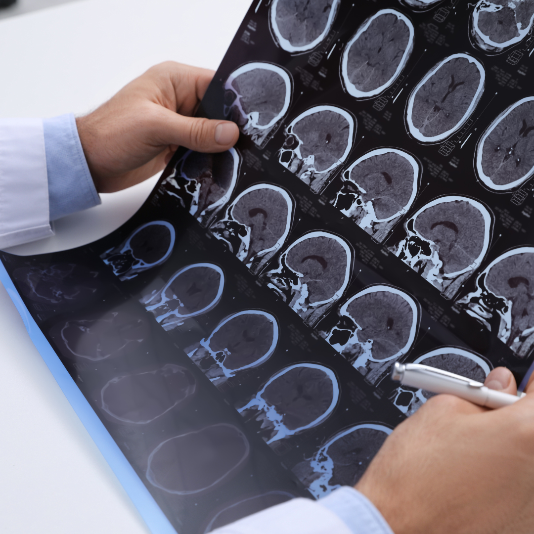 Multiple Sclerosis