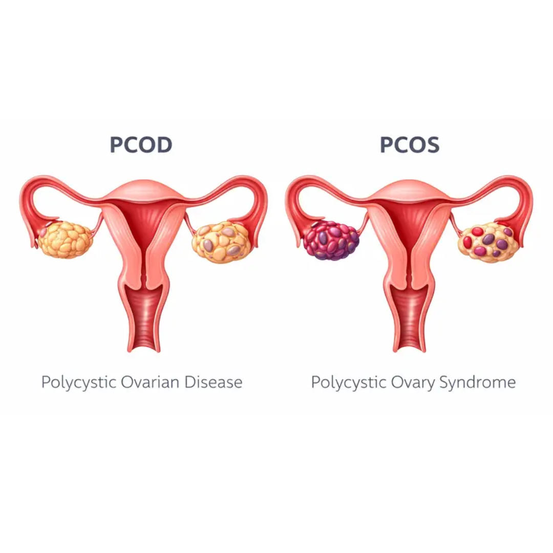 PCOS / PCOD