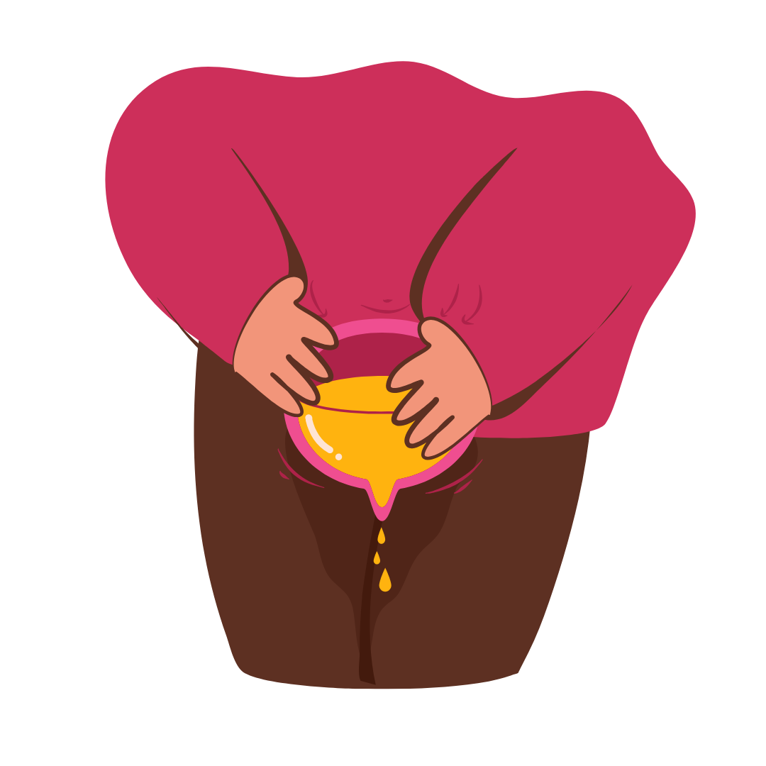 Urinary Incontinence