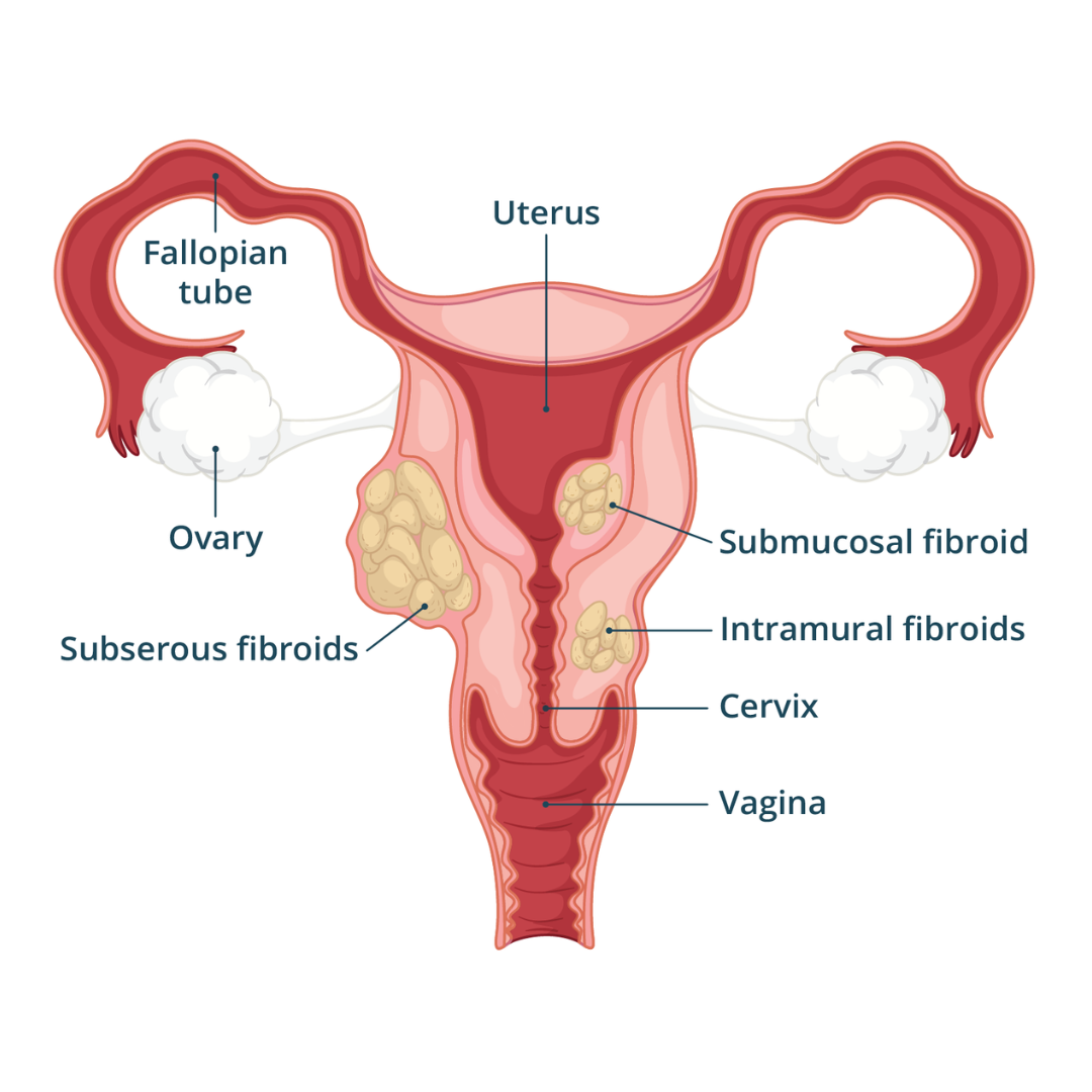 Uterine Fibroids